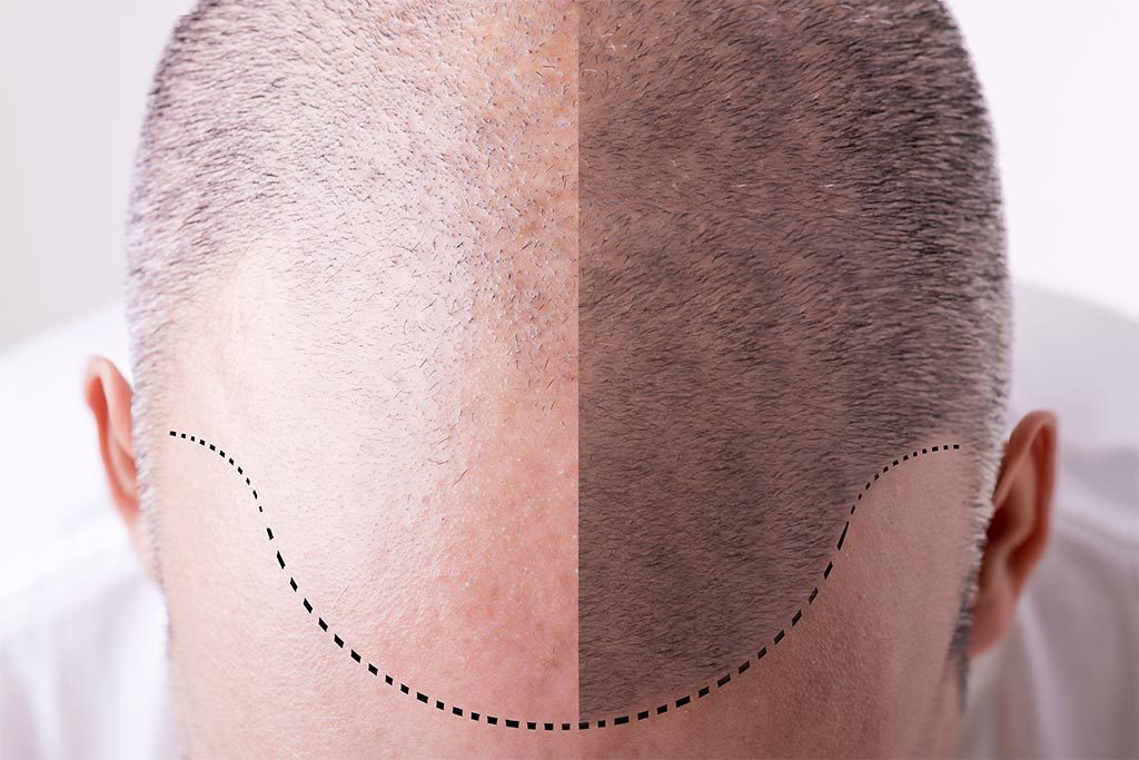 cirugía capilar, trasplante capilar, injerto capilar, trasplante de pelo, injerto de pelo