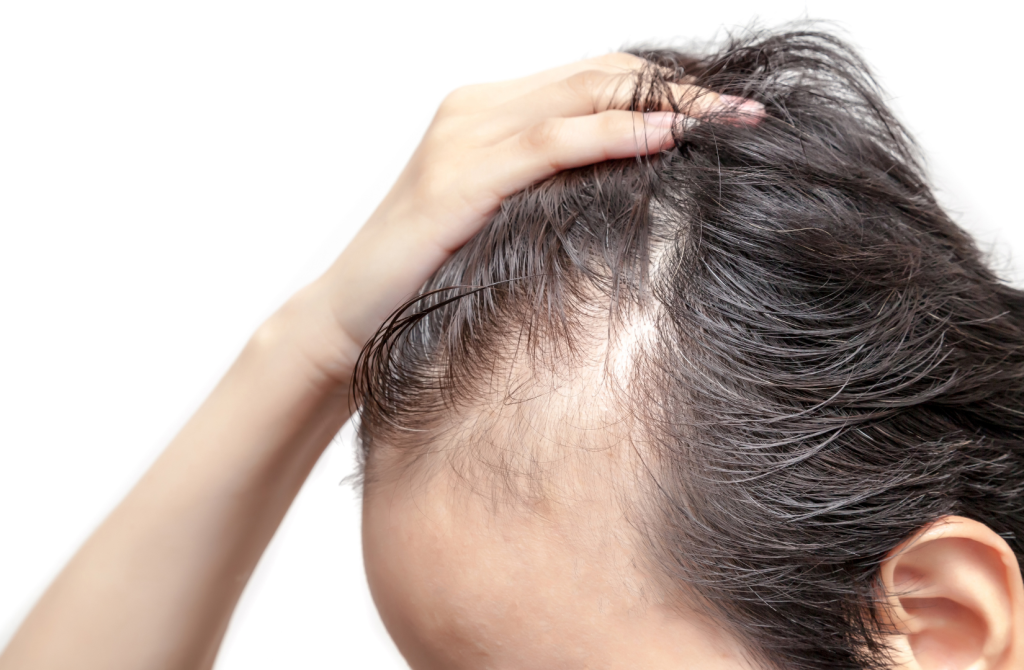 alopecia, calvicie, alopecia androgénica, androgenética