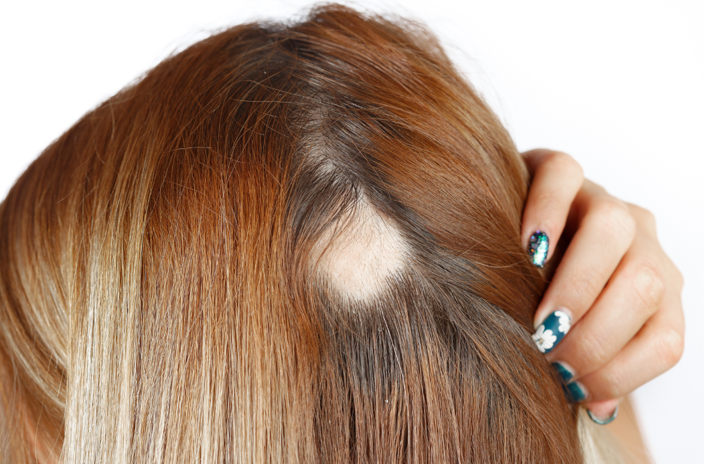 alopecia, calvicie, alopecia androgénica, androgenética